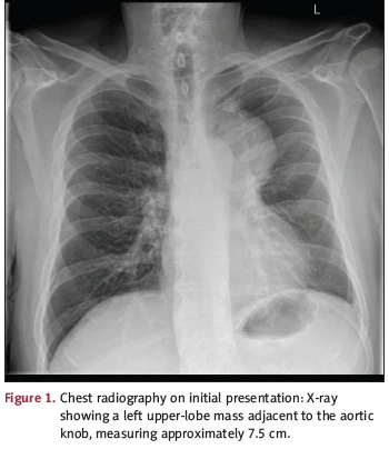 E-cigarettes: X-ray of the cancerous lung